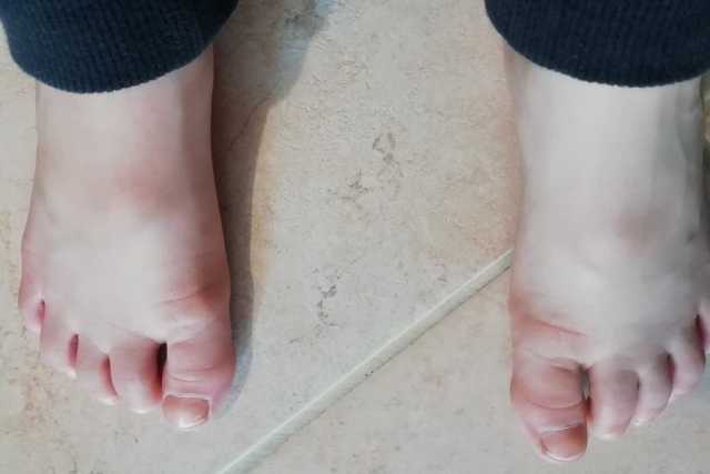 Infiammazioni nodulari ai piedi dei bambini, ricerca barese svela: �C'entra il Coronavirus�